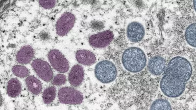 colorized monkeypox virus under a microscope