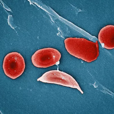 microscopic image of a sickle cell alongside healthy red blood cells